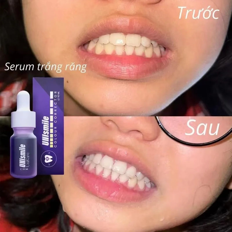 Unismile Teeth Whitening Essen - Teeth Whitening Effective บทวิจารณ์และราคา