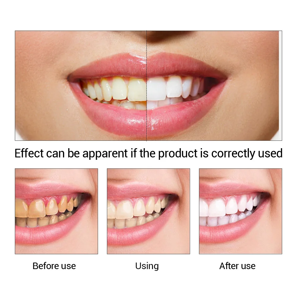 FTEENPLY Teeth Whitening Essen - Teeth Whitening Effective บทวิจารณ์และราคา