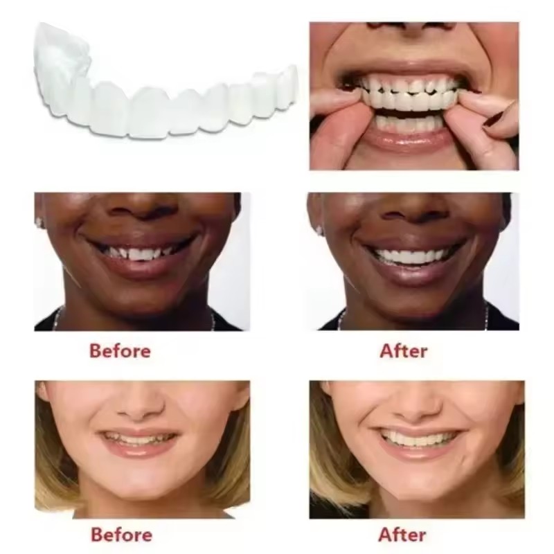 Teeth Veneers Whitening Dentur - Teeth Whitening Veneers บทวิจารณ์และราคา