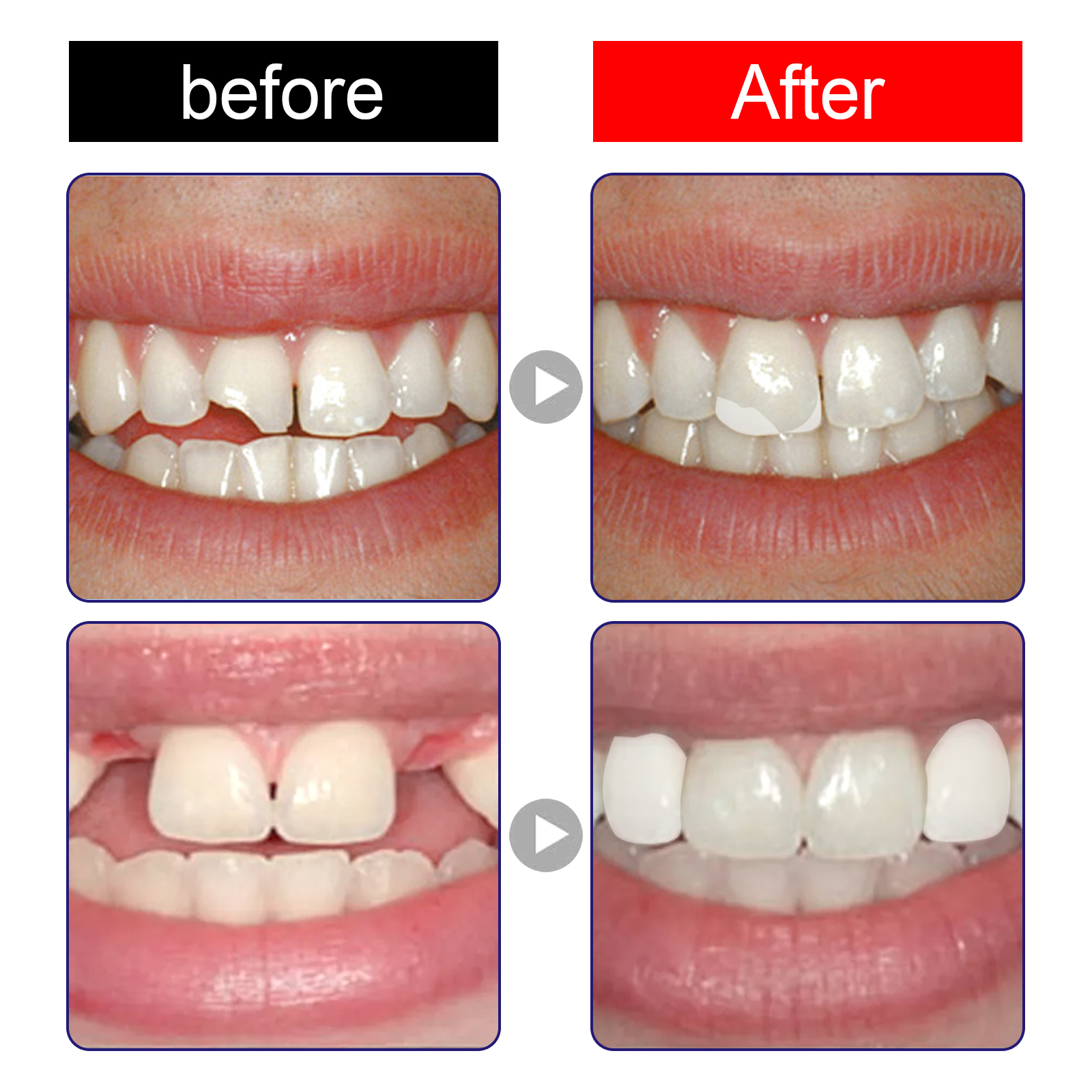 Moldable Dental Filling Materi - Teeth Whitening Uv Kit บทวิจารณ์และราคา