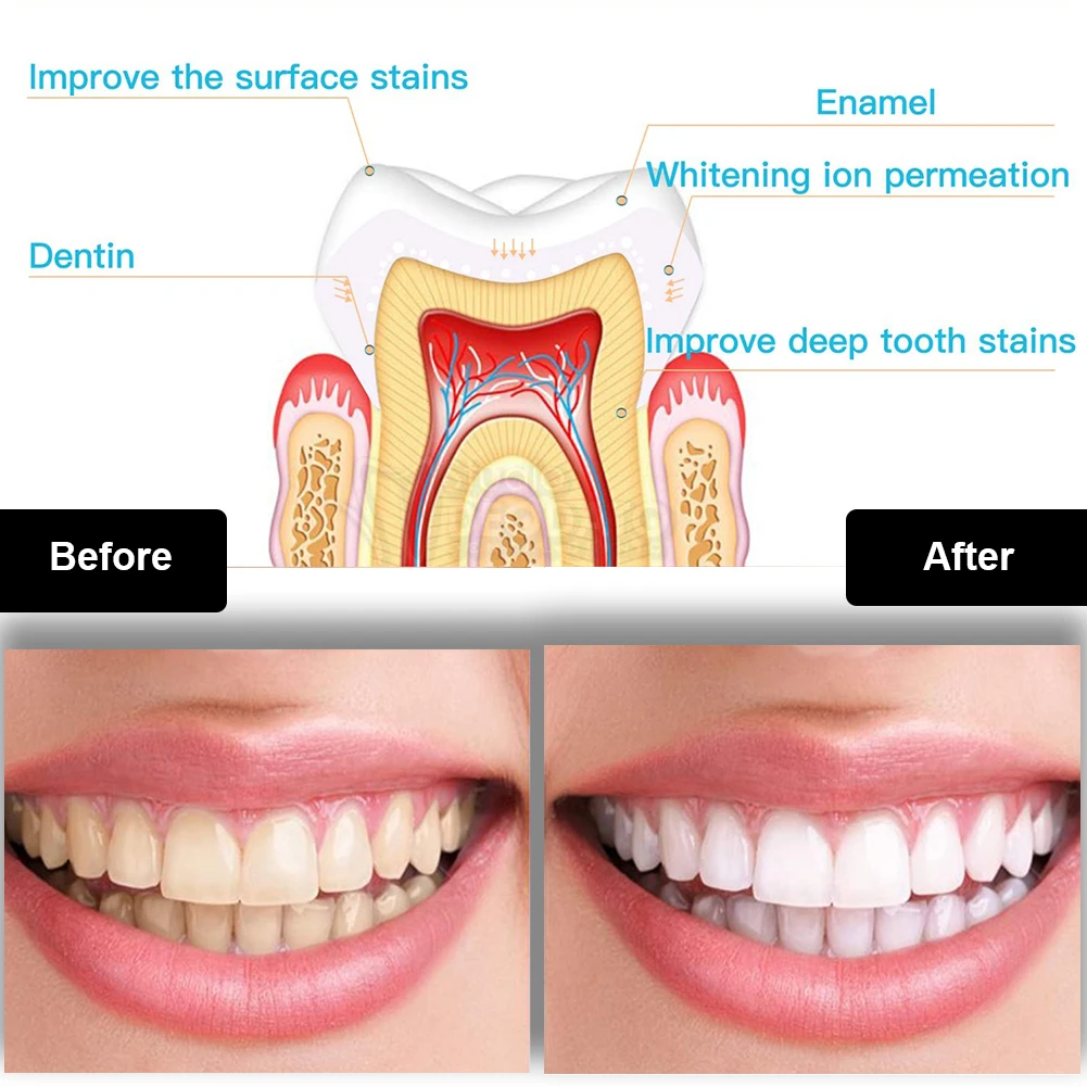 Dental Teeth Whitening Kit Min - Teeth Whitening With Peroxide บทวิจารณ์และราคา