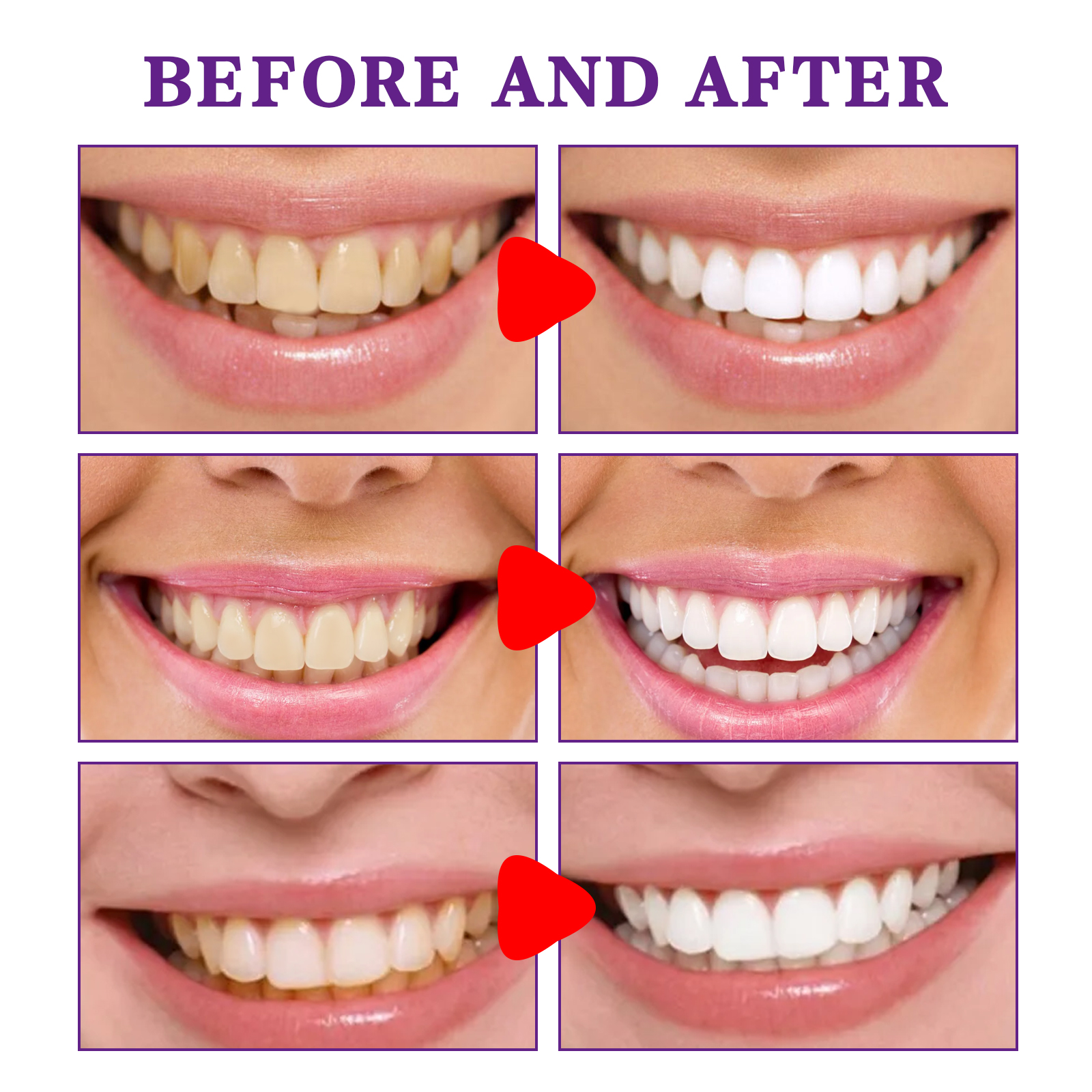 Teeth Cleansing Whitening Toot - Teeth Whitening Korea บทวิจารณ์และราคา