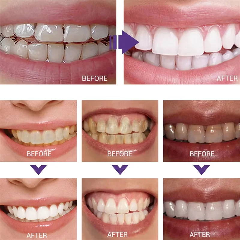 Whitening Toothpaste Teeth Cle - Teeth Whitening Korea บทวิจารณ์และราคา